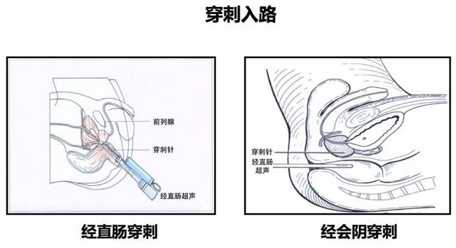 蕪湖市中醫(yī)醫(yī)院首次開展超聲引導(dǎo)下經(jīng)會(huì)陰前列腺穿刺(圖1)