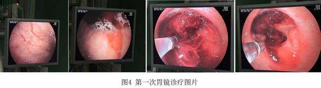 癡呆老人命懸一線，內(nèi)鏡止血彰顯奇功(圖2)