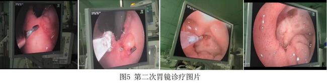 癡呆老人命懸一線，內(nèi)鏡止血彰顯奇功(圖3)
