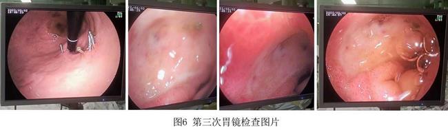 癡呆老人命懸一線，內(nèi)鏡止血彰顯奇功(圖4)