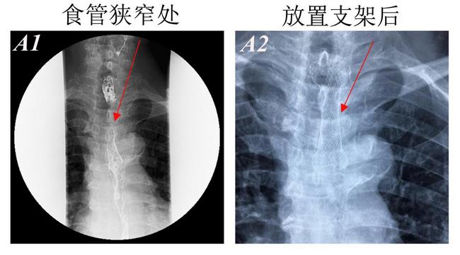 消化科運用多學科會診（MDT）微創(chuàng)診治食管惡性腫瘤侵潤所致食、氣道梗阻(圖4)