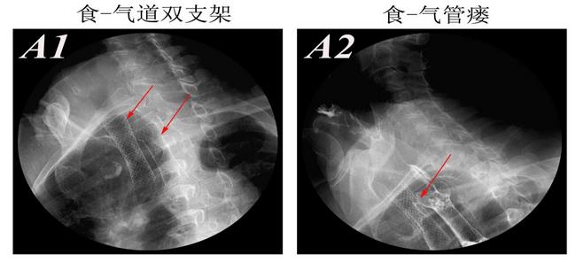 消化科運用多學科會診（MDT）微創(chuàng)診治食管惡性腫瘤侵潤所致食、氣道梗阻(圖8)