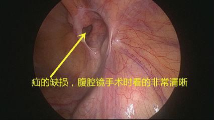 切口小，當(dāng)天即可生活自理——外三科開(kāi)展腹腔鏡下疝氣手術(shù)(圖1)