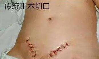 切口小，當(dāng)天即可生活自理——外三科開(kāi)展腹腔鏡下疝氣手術(shù)(圖4)