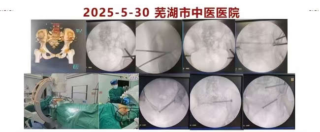 黨建引領業(yè)務 創(chuàng)新技術突破——我院創(chuàng)傷骨科三科黨支部成功開展首例STARR外架微創(chuàng)復位術治療老年復雜骨盆骨折(圖1)
